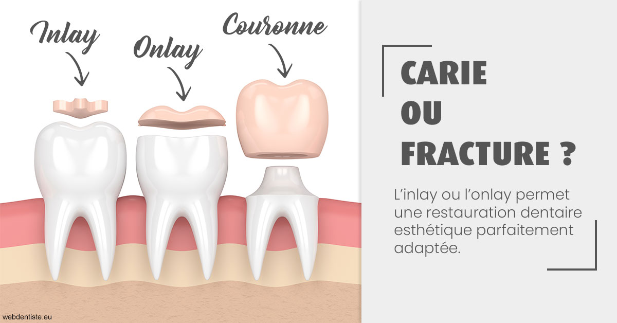 https://dr-muffat-jeandet-julien.chirurgiens-dentistes.fr/T2 2023 - Carie ou fracture 1