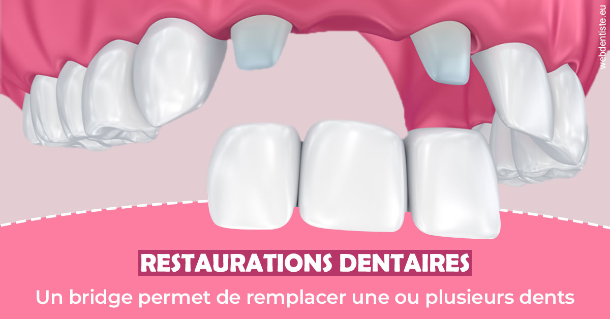 https://dr-muffat-jeandet-julien.chirurgiens-dentistes.fr/Bridge remplacer dents 2