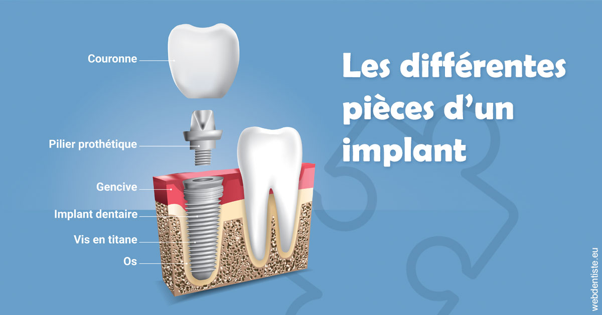 https://dr-muffat-jeandet-julien.chirurgiens-dentistes.fr/Les différentes pièces d’un implant 1