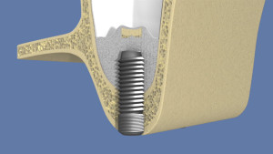 Le comblement de sinus par abord crestal